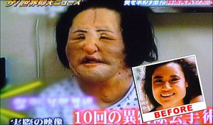 Korean Woman's Face Deformed After DIY Cooking Oil Injections